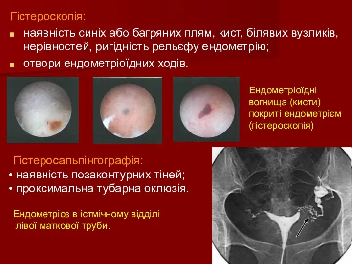 Гістероскопія: наявність синіх або багряних плям, кист, білявих вузликів, нерівностей,