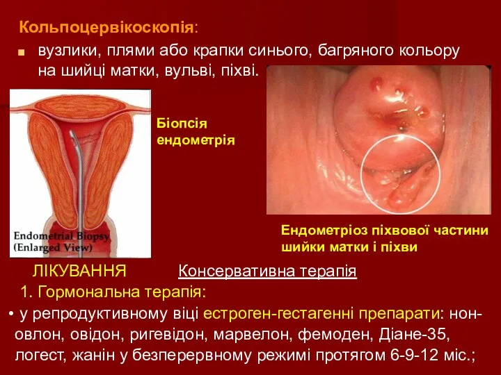 Кольпоцервікоскопія: вузлики, плями або крапки синього, багряного кольору на шийці