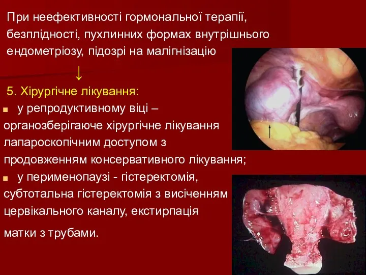 При неефективності гормональної терапії, безплідності, пухлинних формах внутрішнього ендометріозу, підозрі