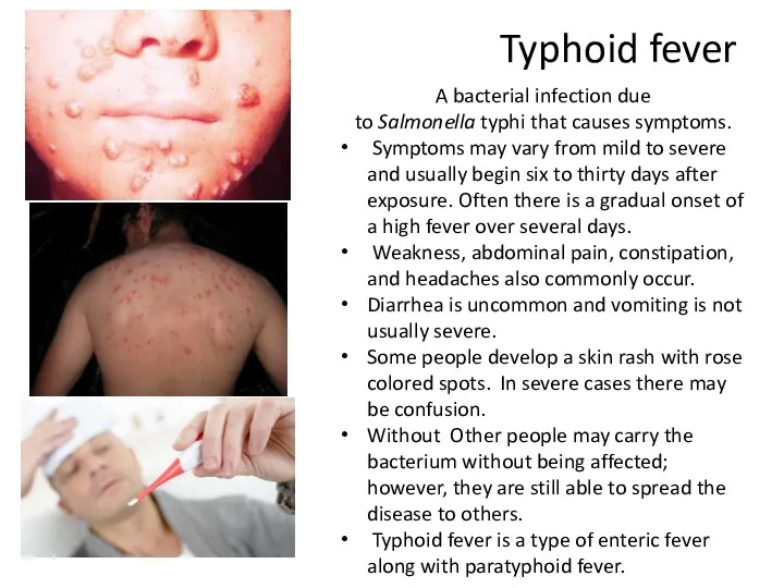Typhoid fever A bacterial infection due to Salmonella typhi that