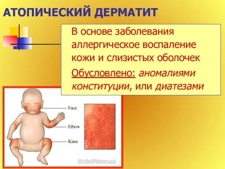 АТОПИЧЕСКИЙ ДЕРМАТИТ В основе заболевания аллергическое воспаление кожи и слизистых оболочек Обусловлено: аномалиями конституции, или диатезами