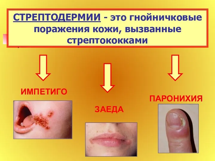 СТРЕПТОДЕРМИИ - это гнойничковые поражения кожи, вызванные стрептококками