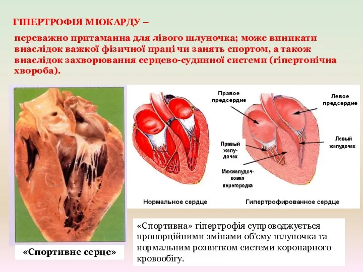 «Спортивне серце» ГІПЕРТРОФІЯ МІОКАРДУ – переважно притаманна для лівого шлуночка;