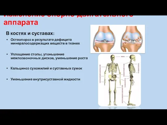 Изменение опорно-двигательного аппарата В костях и суставах: Остеопороз в результате