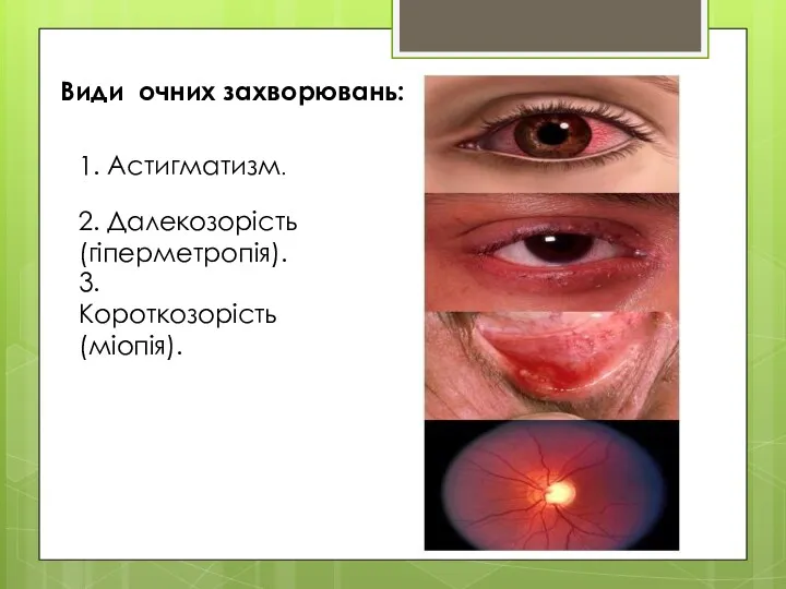 Види очних захворювань: 1. Астигматизм. 2. Далекозорість (гіперметропія). 3. Короткозорість (міопія).