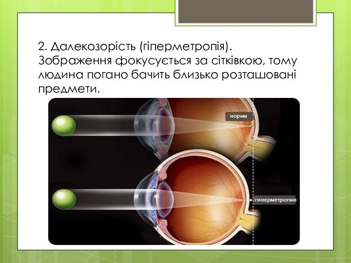 2. Далекозорість (гіперметропія). Зображення фокусується за сітківкою, тому людина погано бачить близько розташовані предмети.