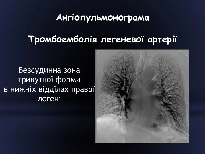Ангіопульмонограма Тромбоемболія легеневої артерії Безсудинна зона трикутної форми в нижніх відділах правої легені