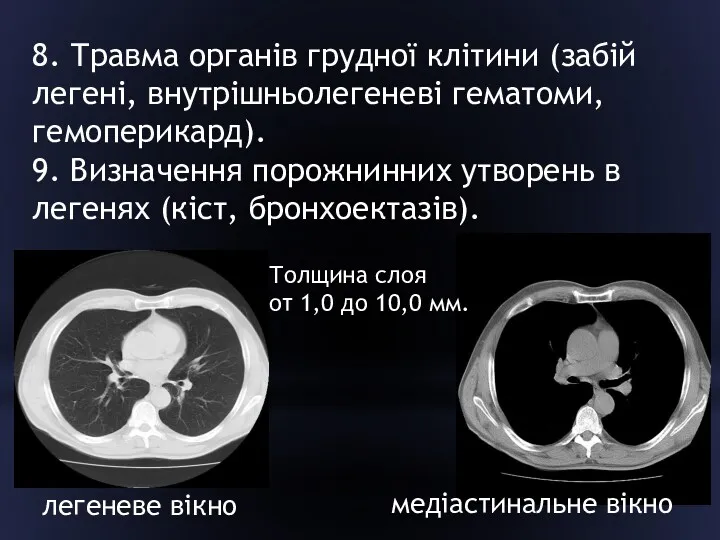 8. Травма органів грудної клітини (забій легені, внутрішньолегеневі гематоми, гемоперикард).