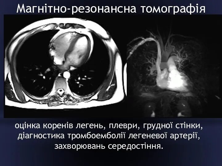 Магнітно-резонансна томографія оцінка коренів легень, плеври, грудної стінки, діагностика тромбоемболії легеневої артерії, захворювань середостіння.