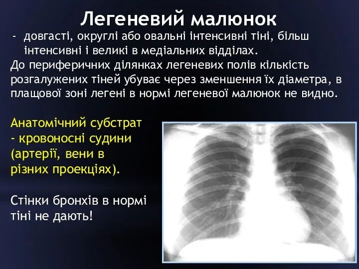 Легеневий малюнок довгасті, округлі або овальні інтенсивні тіні, більш інтенсивні