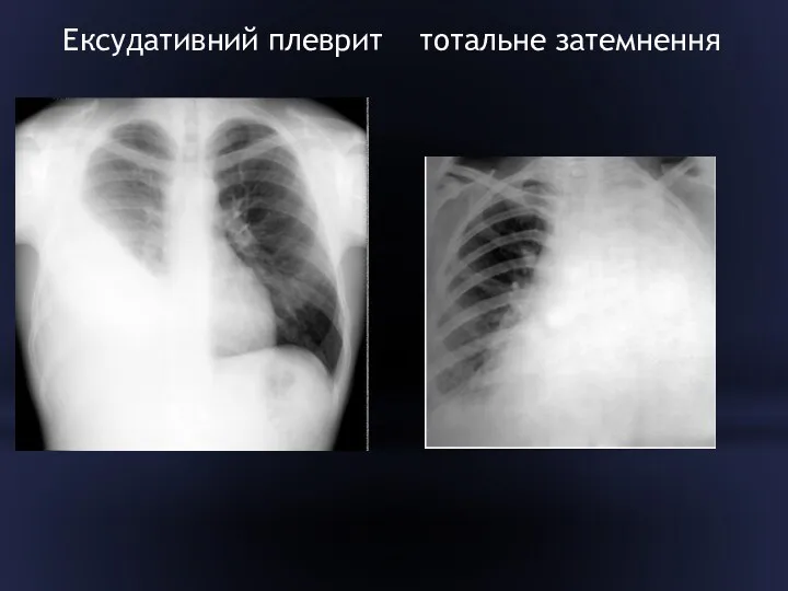 Ексудативний плеврит тотальне затемнення