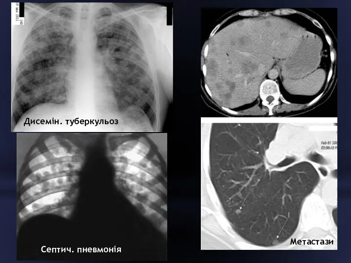 Дисемін. туберкульоз Метастази Септич. пневмонія