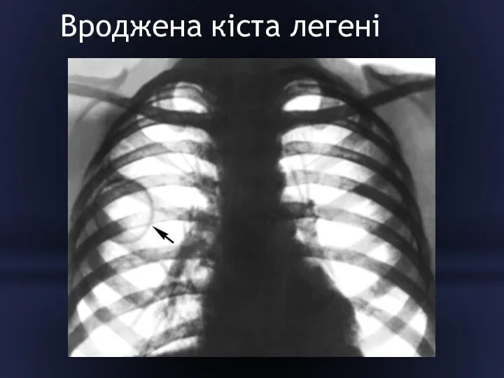 Вроджена кіста легені