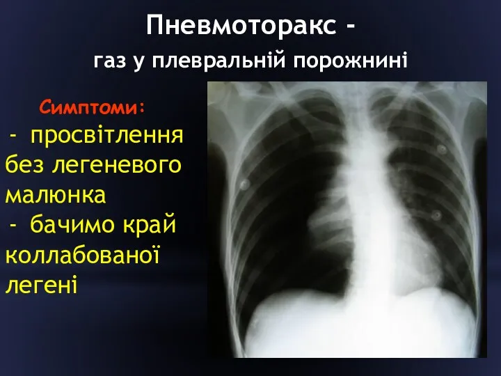 Пневмоторакс - газ у плевральній порожнині Симптоми: просвітлення без легеневого малюнка бачимо край коллабованої легені