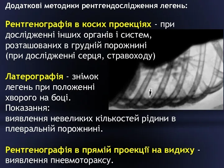 Додаткові методики рентгендослідження легень: Рентгенографія в косих проекціях - при