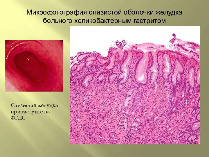 Микрофотография слизистой оболочки желудка больного хеликобактерным гастритом Слизистая желудка при гастрите на ФГДС
