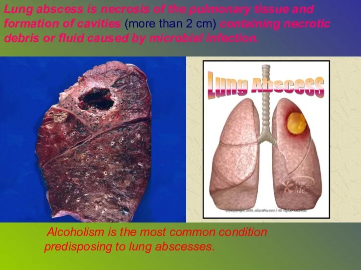 Lung abscess is necrosis of the pulmonary tissue and formation of cavities (more