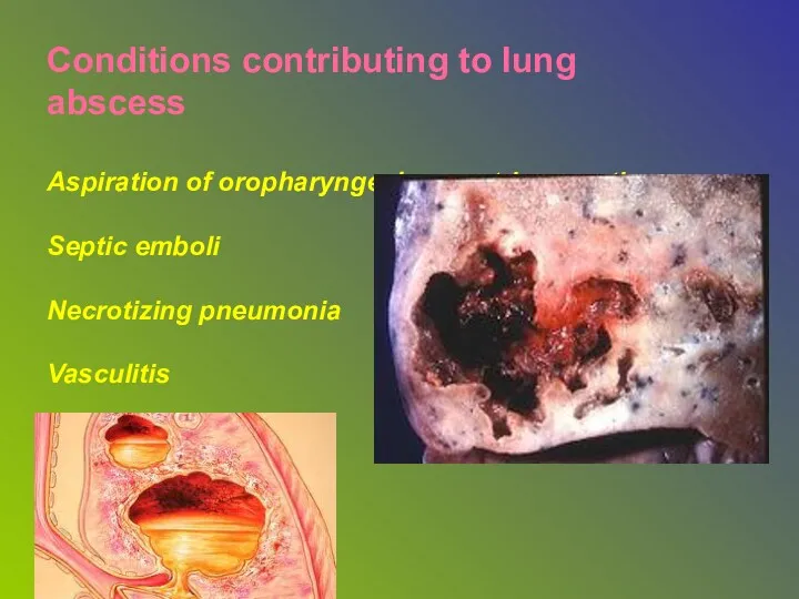 Conditions contributing to lung abscess Aspiration of oropharyngeal or gastric secretion Septic emboli