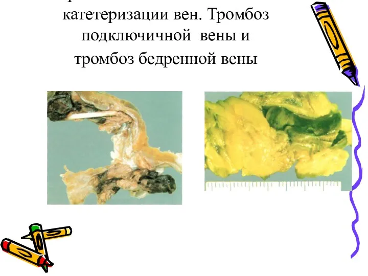 Тромботические осложнения катетеризации вен. Тромбоз подключичной вены и тромбоз бедренной вены