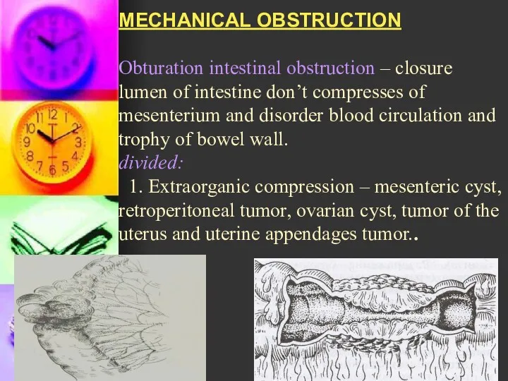 MECHANICAL OBSTRUCTION Obturation intestinal obstruction – closure lumen of intestine