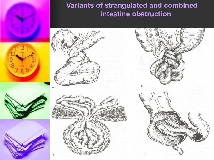 . Variants of strangulated and combined intestine obstruction