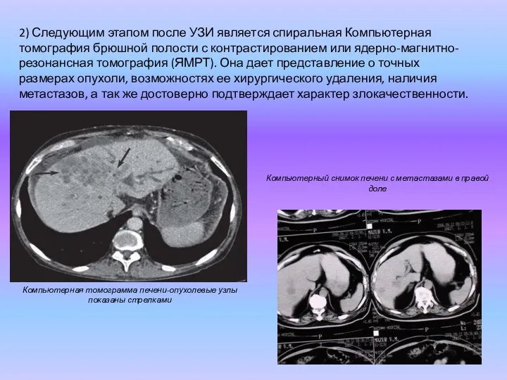 2) Следующим этапом после УЗИ является спиральная Компьютерная томография брюшной