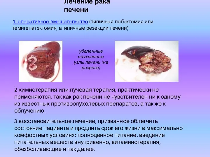 Лечение рака печени 1. оперативное вмешательство (типичная лобэктомия или гемигепатэктомия, атипичные резекции печени)