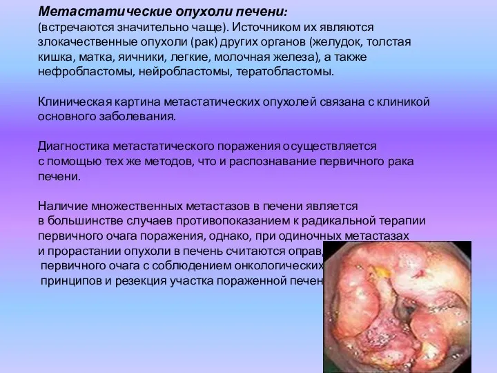Метастатические опухоли печени: (встречаются значительно чаще). Источником их являются злокачественные опухоли (рак) других