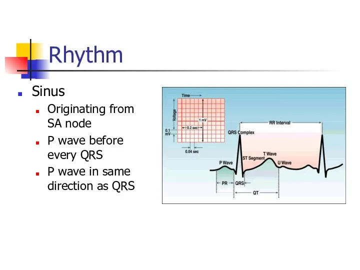 Rhythm Sinus Originating from SA node P wave before every QRS P wave