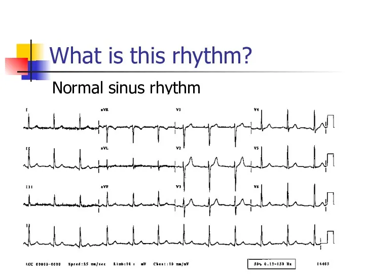 What is this rhythm? Normal sinus rhythm