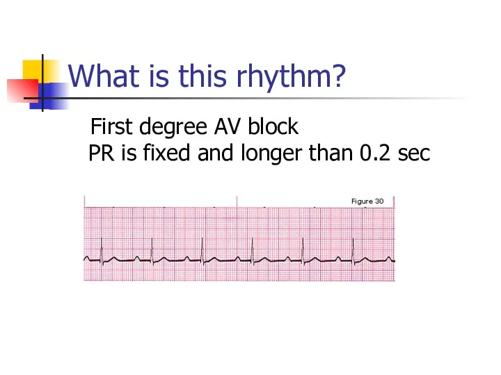 What is this rhythm? First degree AV block PR is fixed and longer than 0.2 sec
