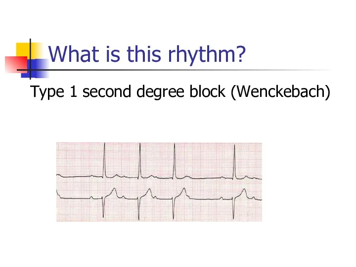 What is this rhythm? Type 1 second degree block (Wenckebach)