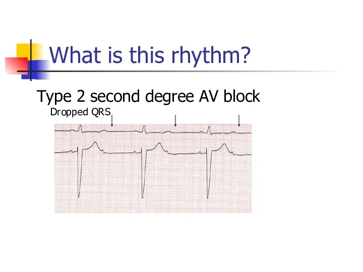 What is this rhythm? Type 2 second degree AV block Dropped QRS