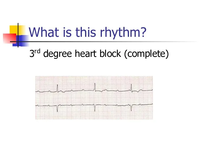 What is this rhythm? 3rd degree heart block (complete)