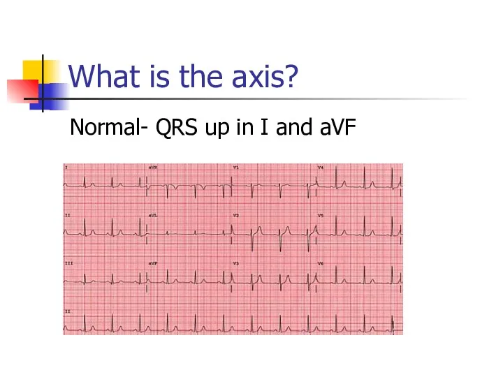 What is the axis? Normal- QRS up in I and aVF