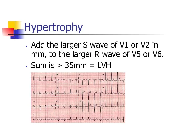 Hypertrophy Add the larger S wave of V1 or V2 in mm, to