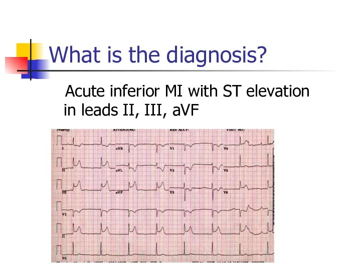 What is the diagnosis? Acute inferior MI with ST elevation in leads II, III, aVF