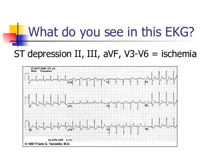 What do you see in this EKG? ST depression II, III, aVF, V3-V6 = ischemia