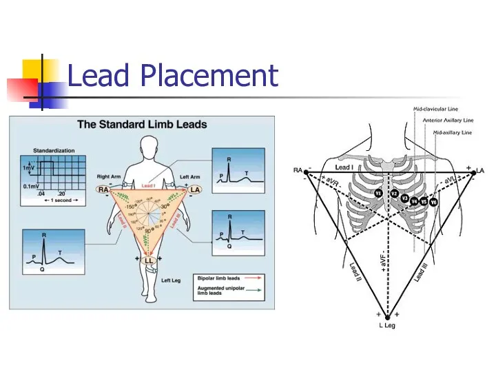 Lead Placement aVF
