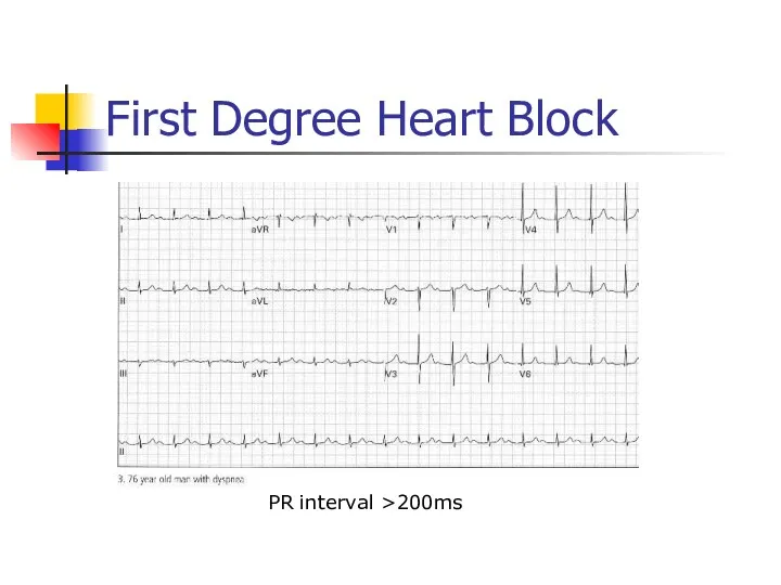 First Degree Heart Block PR interval >200ms