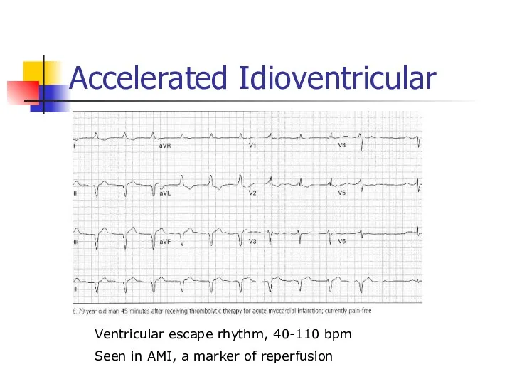 Accelerated Idioventricular Ventricular escape rhythm, 40-110 bpm Seen in AMI, a marker of reperfusion