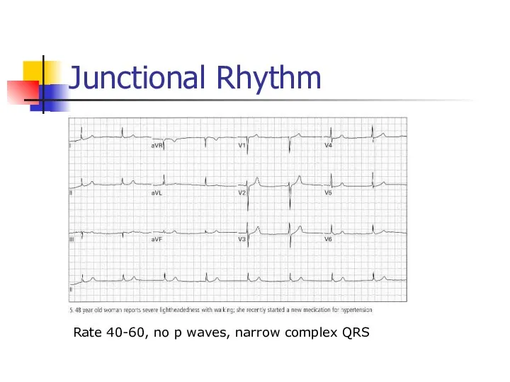 Junctional Rhythm Rate 40-60, no p waves, narrow complex QRS