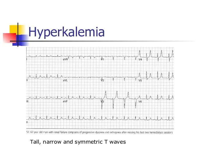 Hyperkalemia Tall, narrow and symmetric T waves