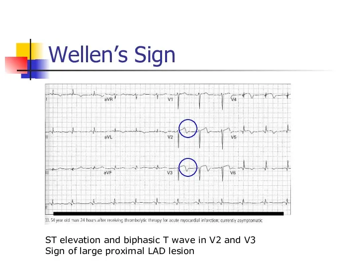 Wellen’s Sign ST elevation and biphasic T wave in V2 and V3 Sign