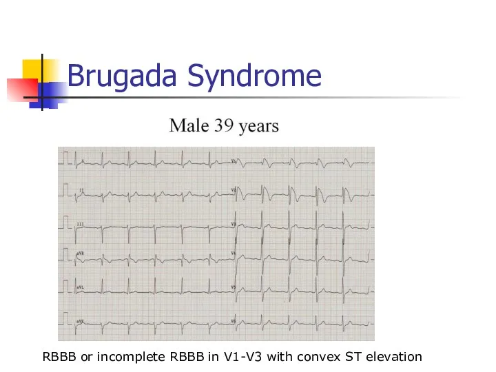 Brugada Syndrome RBBB or incomplete RBBB in V1-V3 with convex ST elevation