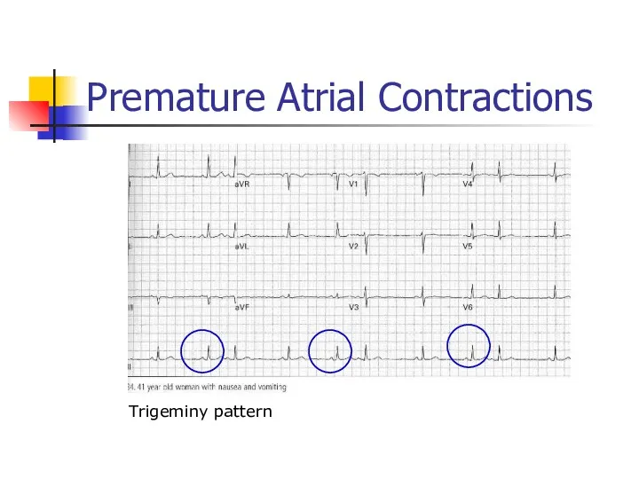 Premature Atrial Contractions Trigeminy pattern