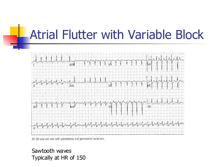 Atrial Flutter with Variable Block Sawtooth waves Typically at HR of 150