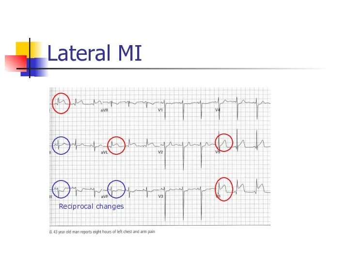 Lateral MI Reciprocal changes