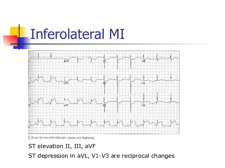 Inferolateral MI ST elevation II, III, aVF ST depression in aVL, V1-V3 are reciprocal changes