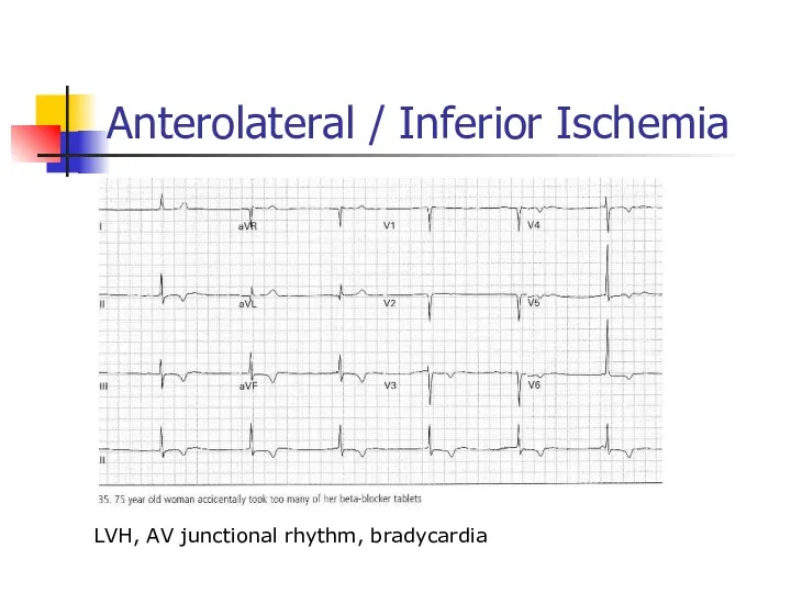 Anterolateral / Inferior Ischemia LVH, AV junctional rhythm, bradycardia